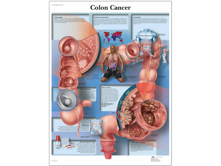 Anatomical Chart - Colon Cancer