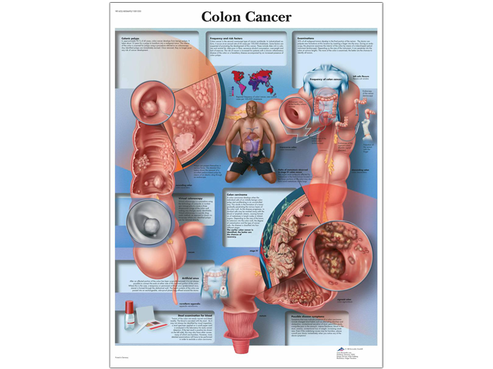 Anatomical Chart - Colon Cancer